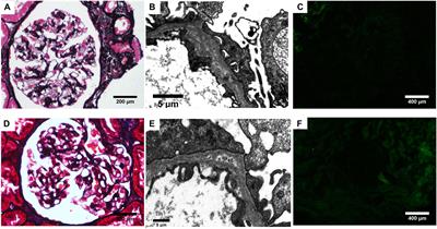 Combination of a Novel Genetic Variant in CFB Gene and a Pathogenic Variant in COL4A5 Gene in a Sibling Renal Disease: A Case Report